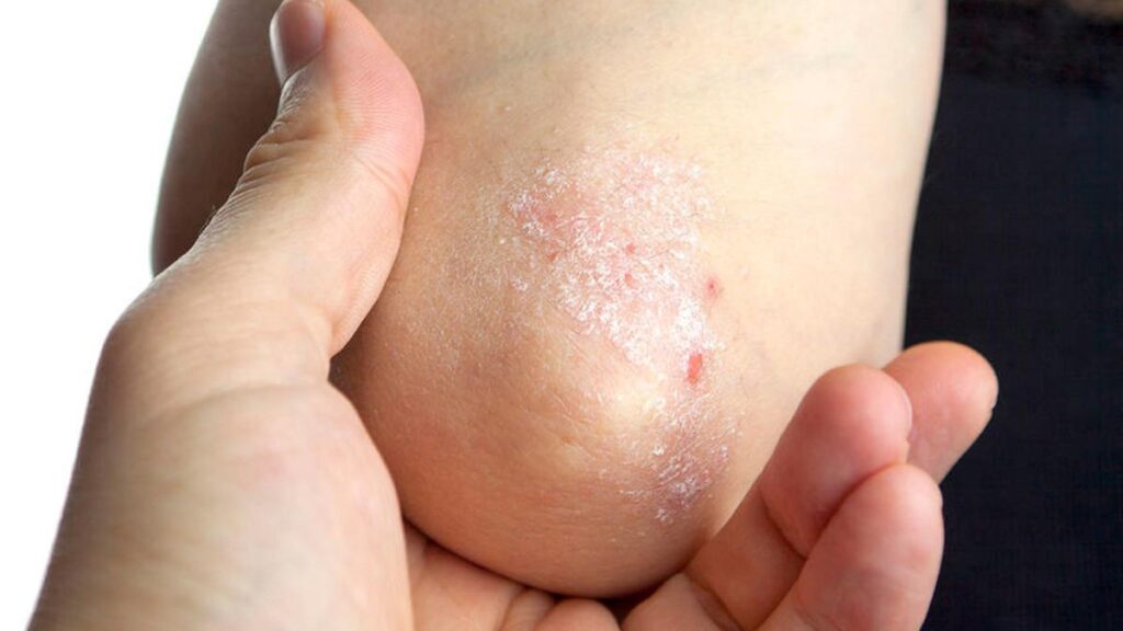 Mengenal Psoriasis Vulgaris, Penyebab, Gejala dan Dampak Negatifnya