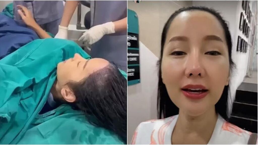 6 Potret Lucinta Luna Transplantasi Rambut di Thailand, Akui Saat Botak