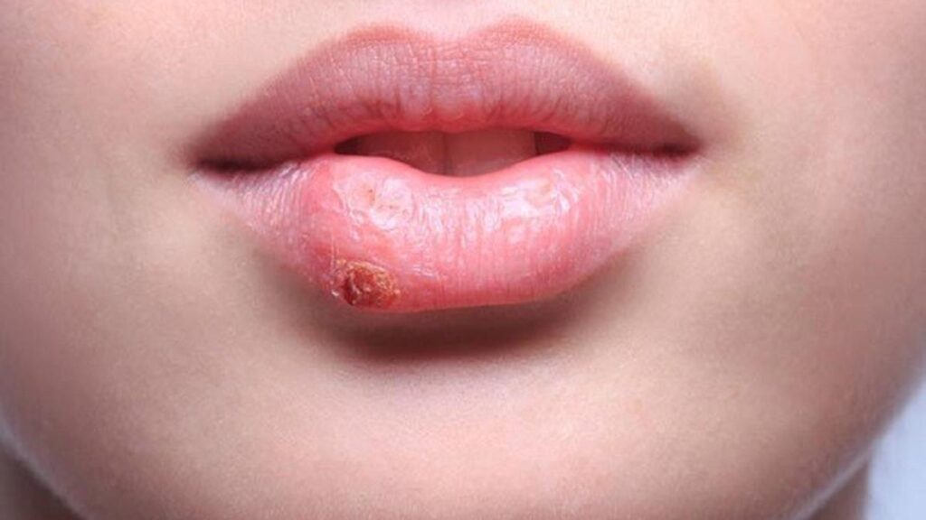 8 Jenis Herpes yang Bisa Menyerang Manusia, Lengkap dengan Penyebabnya