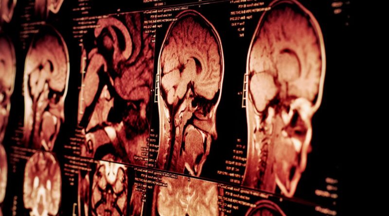 Ciri-Ciri Kanker Otak, Penyebab, Faktor Risiko, dan Pengobatannya