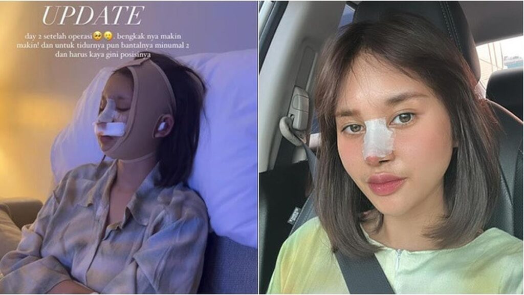 6 Potret Permesta Dhyaz Anak Farida Nurhan Kembali Operasi Hidung, Sebelumnya Sempat Infeksi
