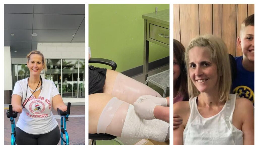 Kehilangan empat anggota badan akibat komplikasi flu, kisah wanita ini bikin haru