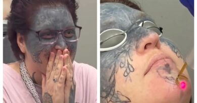 Hingga mengidap penyakit bipolar, wajah wanita ini sengaja ditato oleh mantan pacarnya tanpa izin