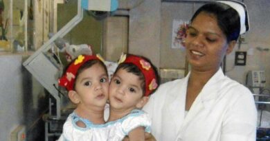 Ditangani 23 Dokter, Begini Kisah Bocah Kembar Siam yang Terpisah Setelah 12 Jam Dioperasi
