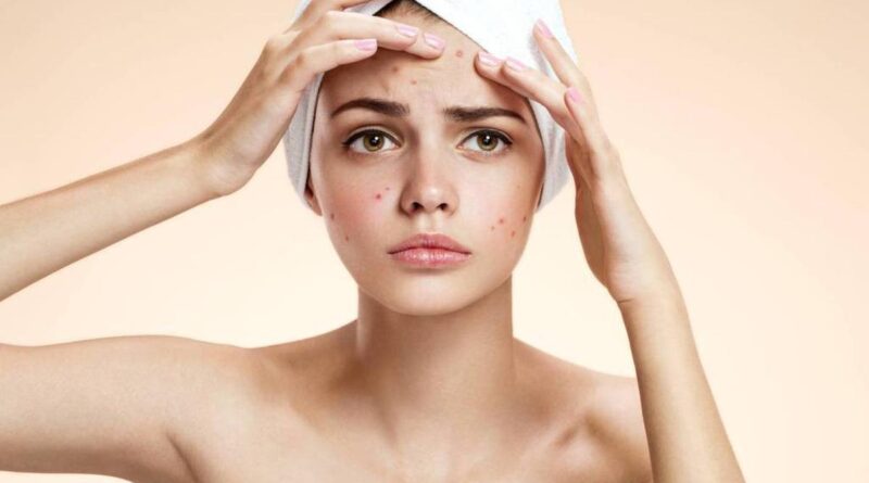 Hilangkan jerawat di wajah dengan 10 bahan alami ini, kulit akan kembali mulus dengan cepat dan aman